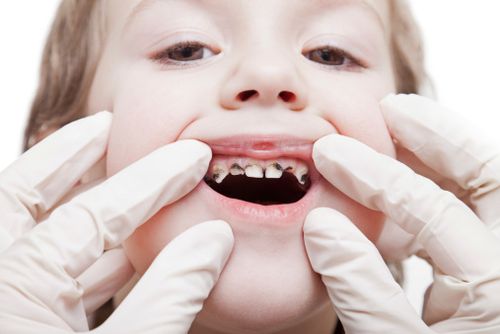 Zubný kaz u detí